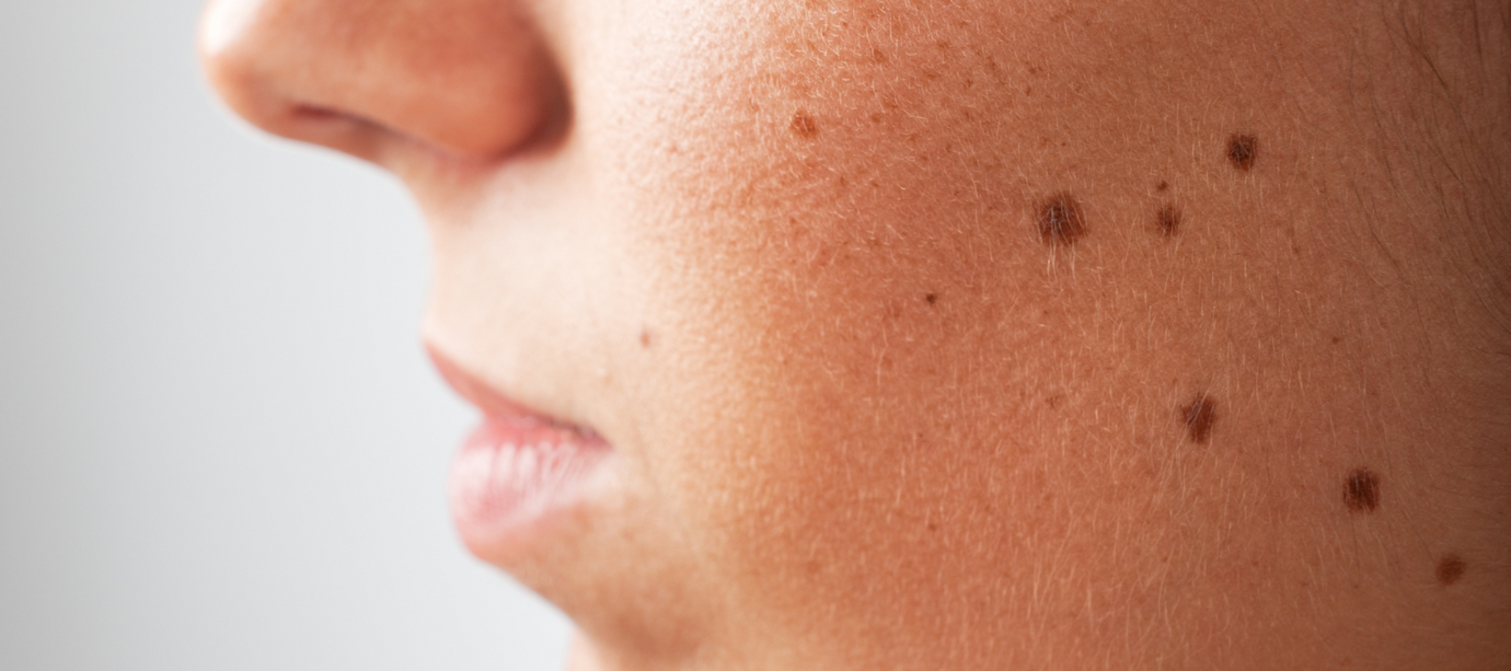 Understanding Melanoma: The Importance of Early Detection and Prevention
