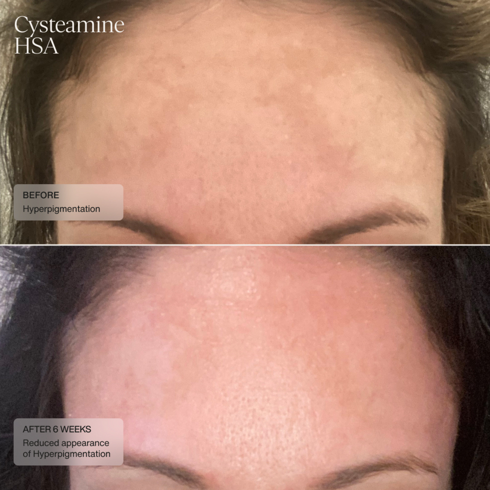 Pigment and Tone Correcting Mask (CAD) Clinical Results